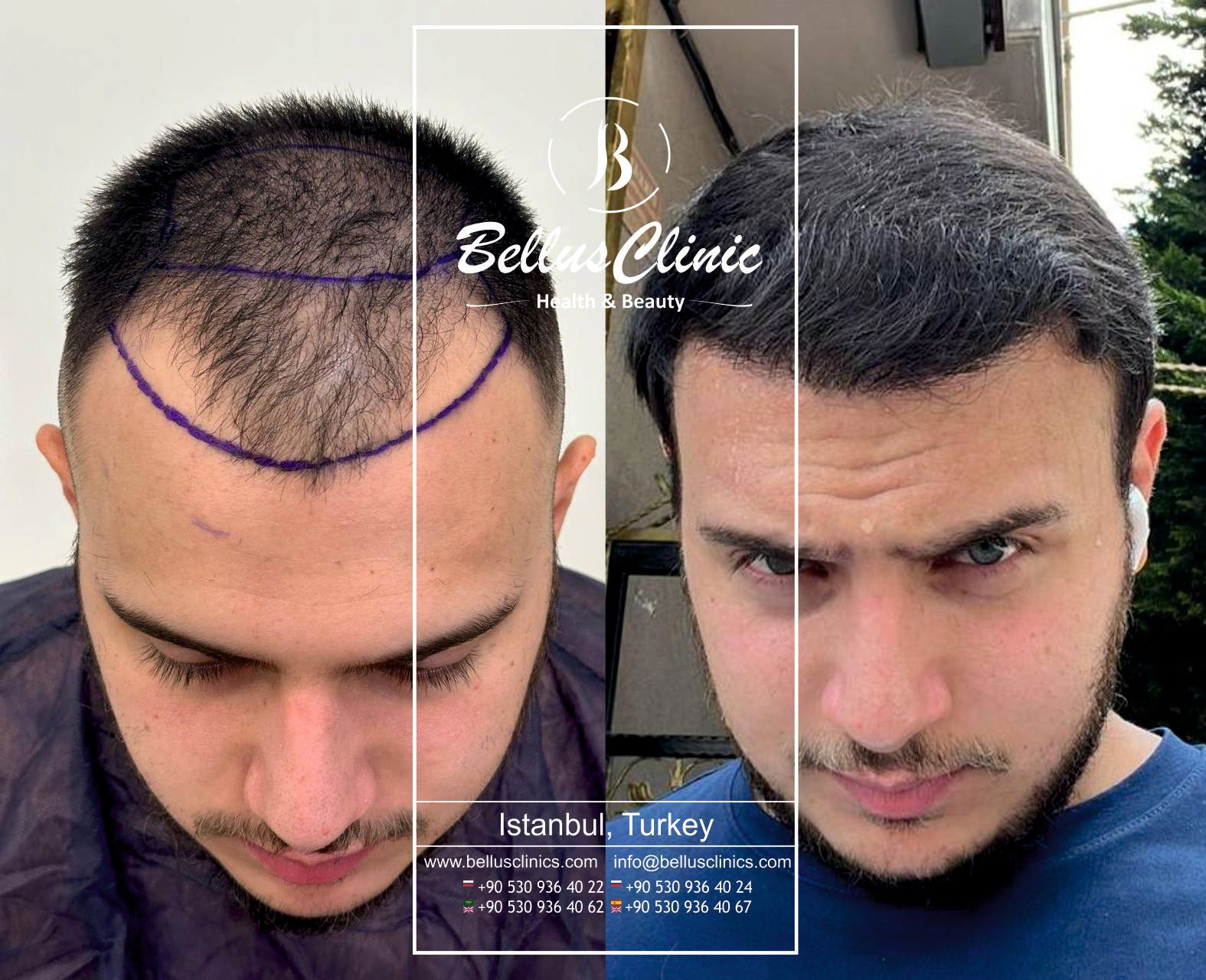 Hair Transplant Result DHI technology 