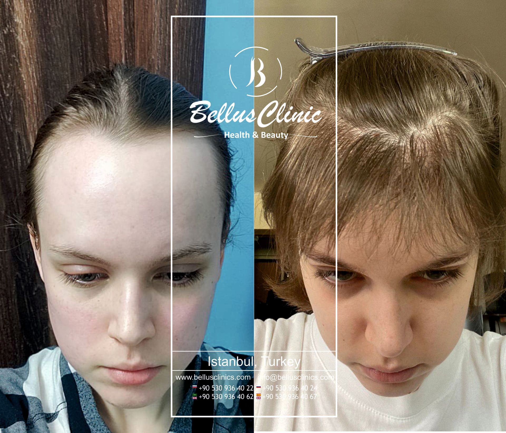 Forehead reduction for a young woman