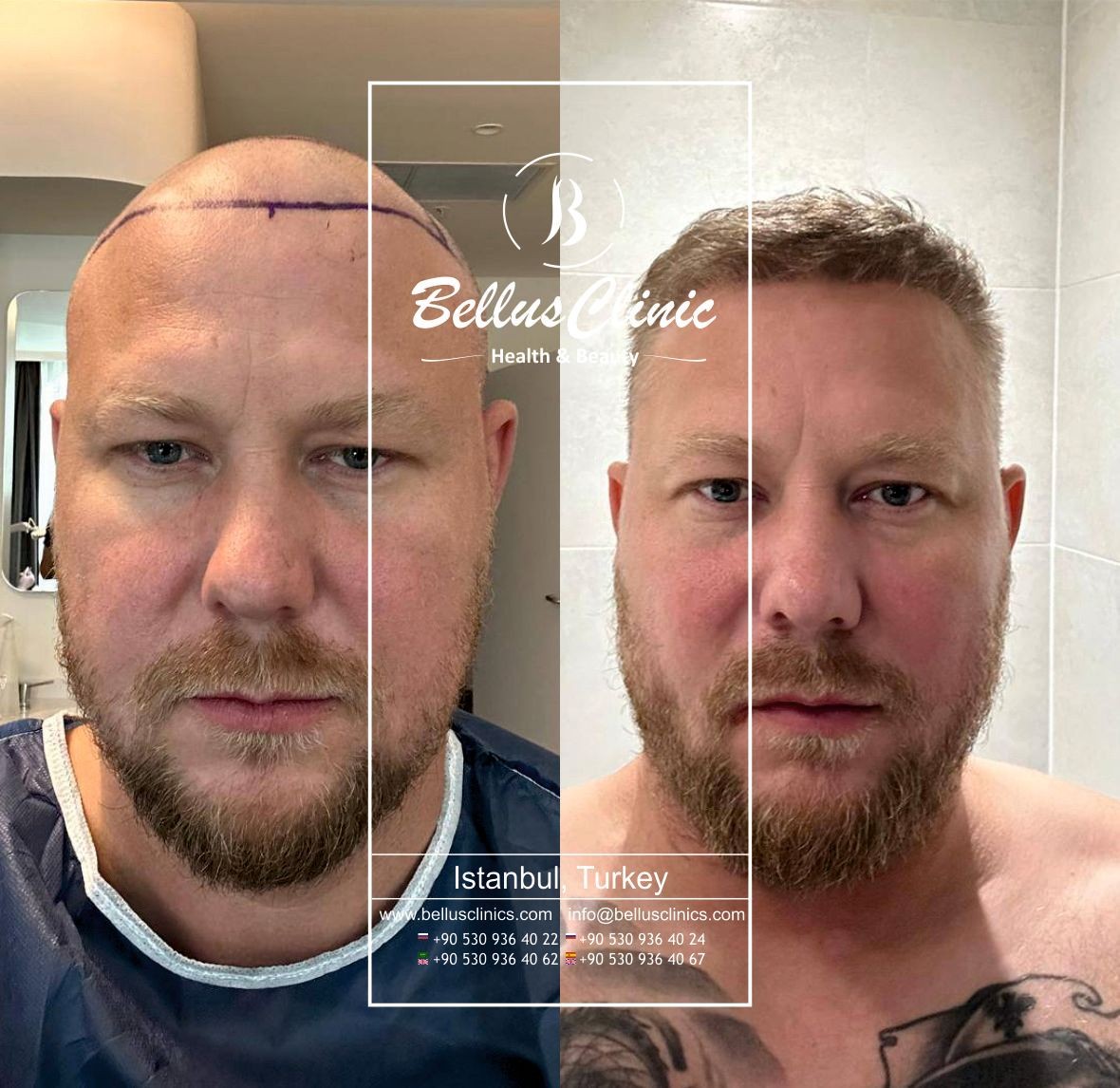 A blond man before and after hair transplant 